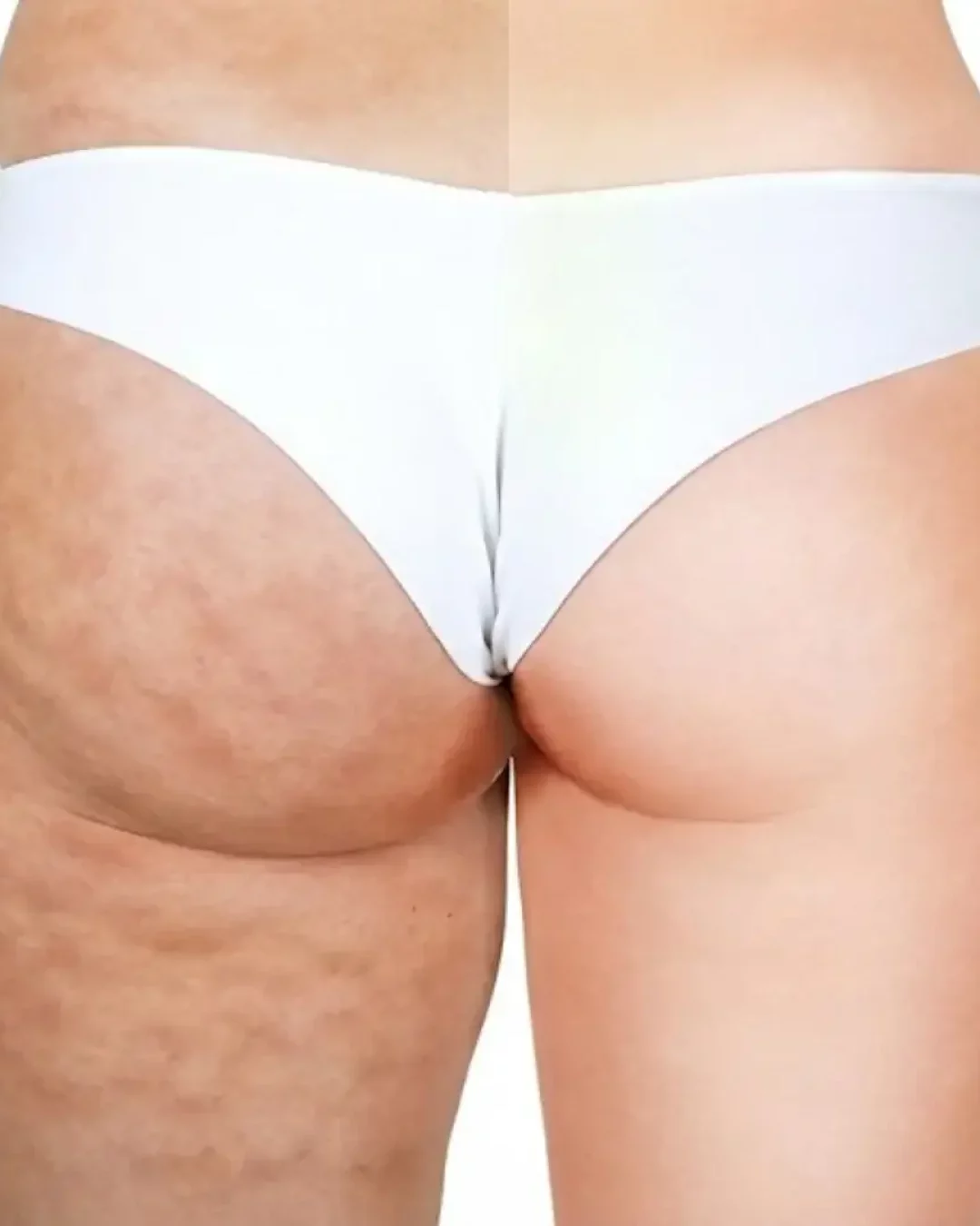 Avant après cellulite sur les cuisses illustrant l’efficacité d’un cours de massage amincissant avec Sophie Antille